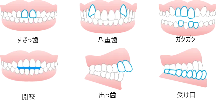 このような歯並びに対応します