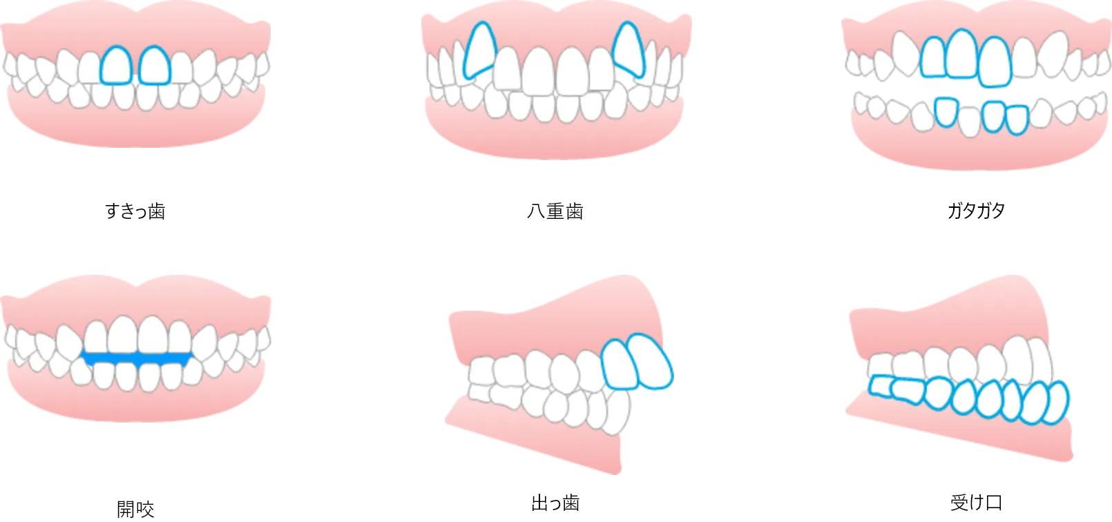このような歯並びに対応します